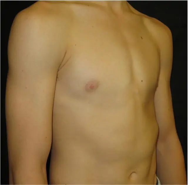 Mild symmetric pectus carinatum