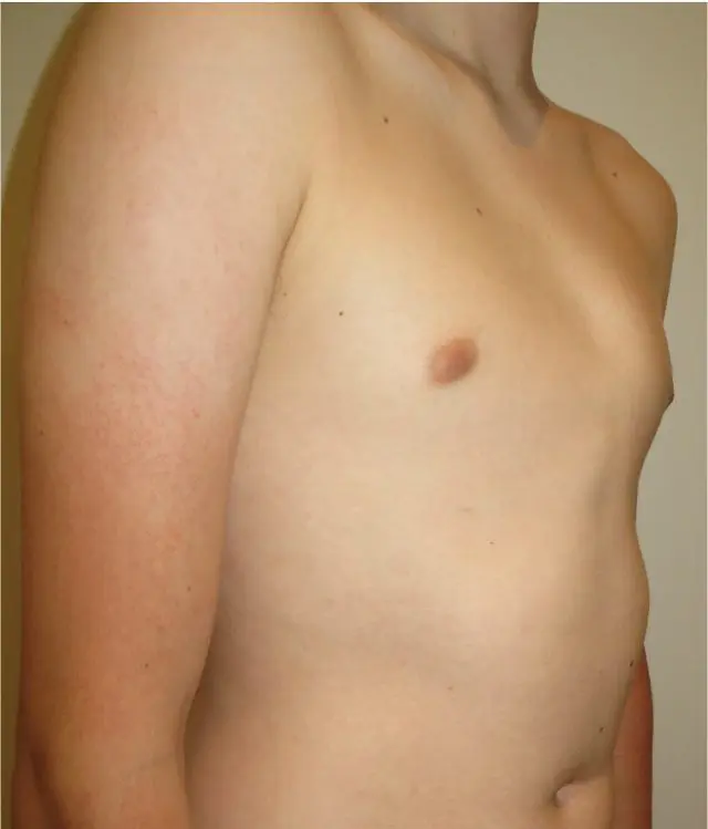 Severe symmetric pectus carinatum keel chest