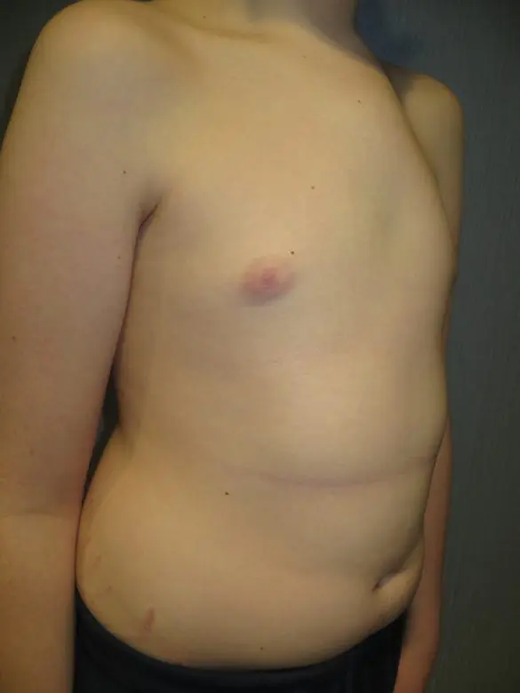 Superior chondromanubrial pectus carinatum upper sternal variant