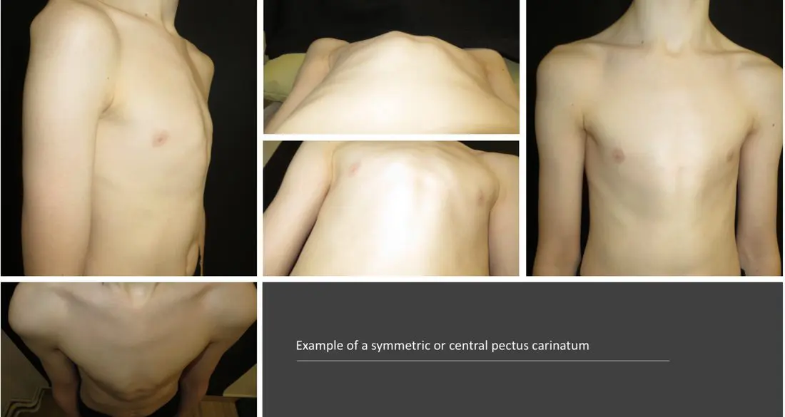 Female pectus carinatum presentation