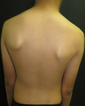 Postural asymmetry of scapula