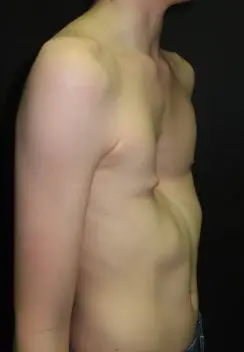Before — Teenager, 18 months of vacuum bell therapy for pectus excavatum