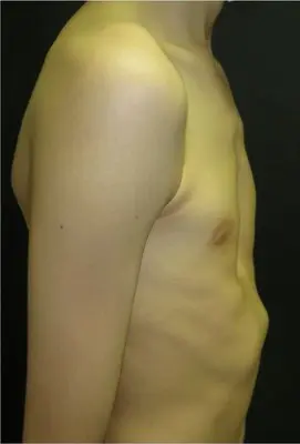 Before — Patient, rib flare brace treatment for pectus excavatum with rib flaring