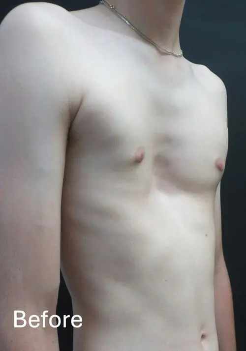 Before — Young adult with pectus excavatum, following 2-bar Nuss procedure and subsequent bar removal