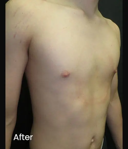 After — Teenager aged 16, after 10 months of vacuum bell therapy for pectus excavatum