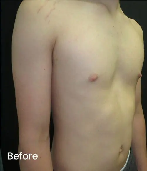 Before — Young adult with pectus excavatum, following 2-bar Nuss procedure and subsequent bar removal