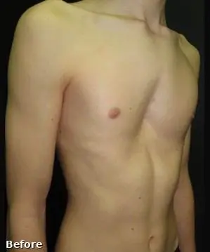 After — Young patient, vacuum bell therapy for pectus excavatum
