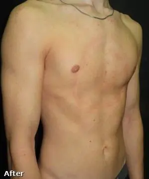 Before — Young patient, vacuum bell therapy for pectus excavatum