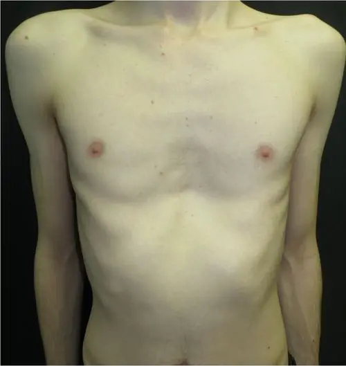 After — Young adult, following Nuss procedure and bar removal for pectus excavatum