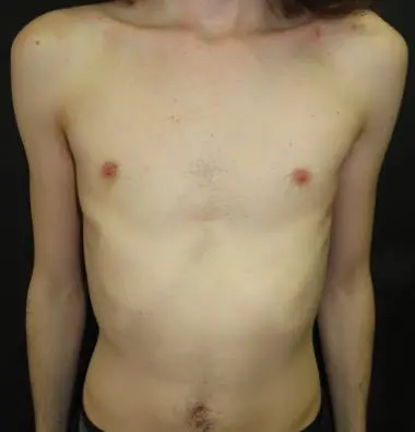 Before — Young adult, following Nuss procedure and bar removal for pectus excavatum