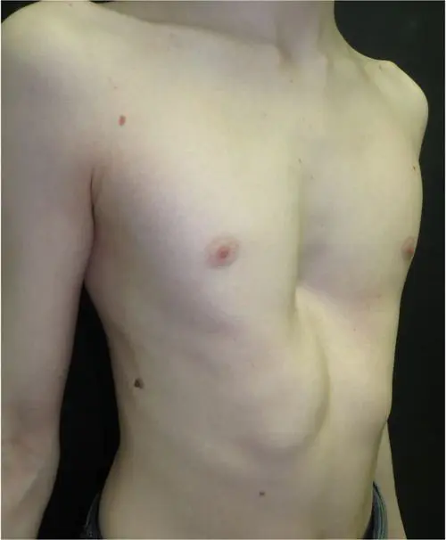 After — Teenager, vacuum bell therapy and rib flare brace for pectus excavatum