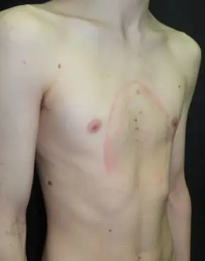 Before — Teenager, vacuum bell therapy and rib flare brace for pectus excavatum