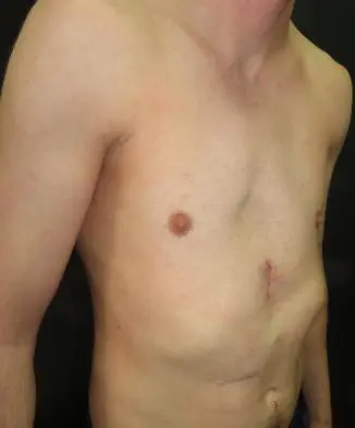 After — Adult, following pectus implant surgery for pectus excavatum