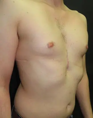 After — Adult, following pectus implant for severe pectus excavatum