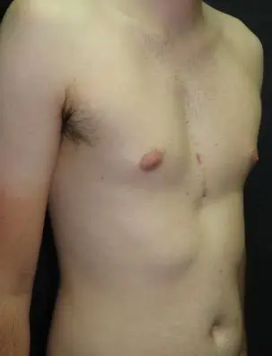 After — Adult aged 27, following pectus implant surgery for pectus excavatum