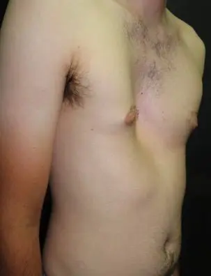 Before — Adult aged 27, following pectus implant surgery for pectus excavatum