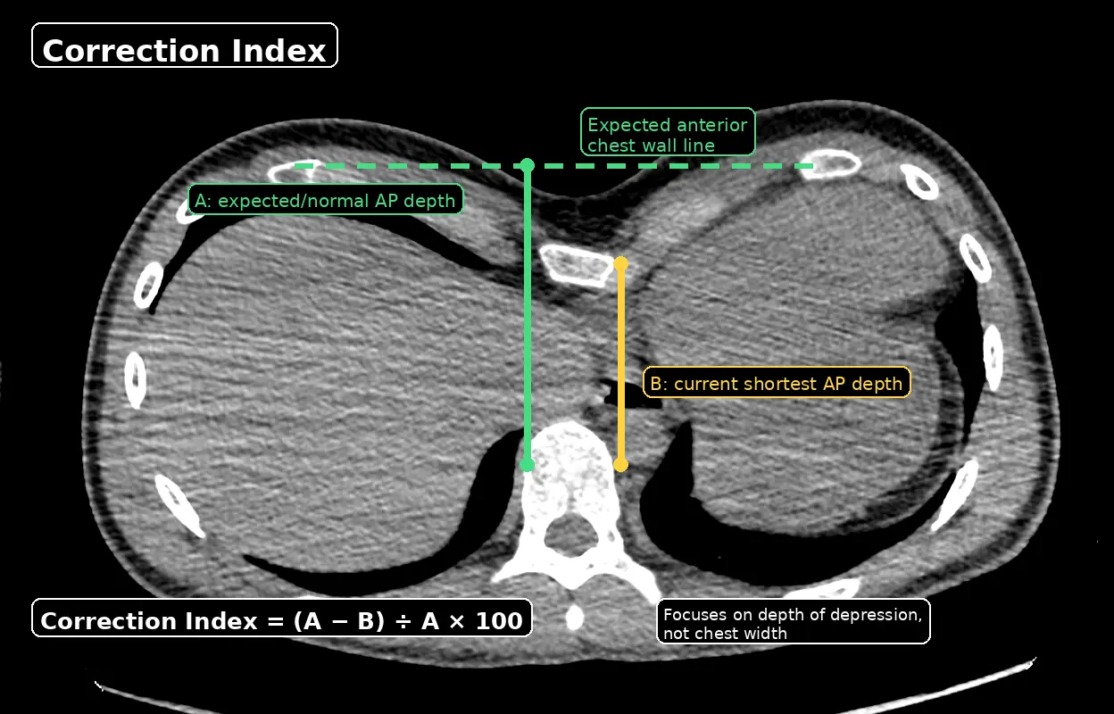 CT chest showing Correction Index measurement