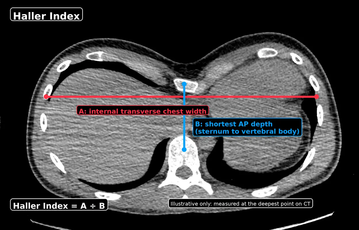 CT chest showing Haller Index measurement