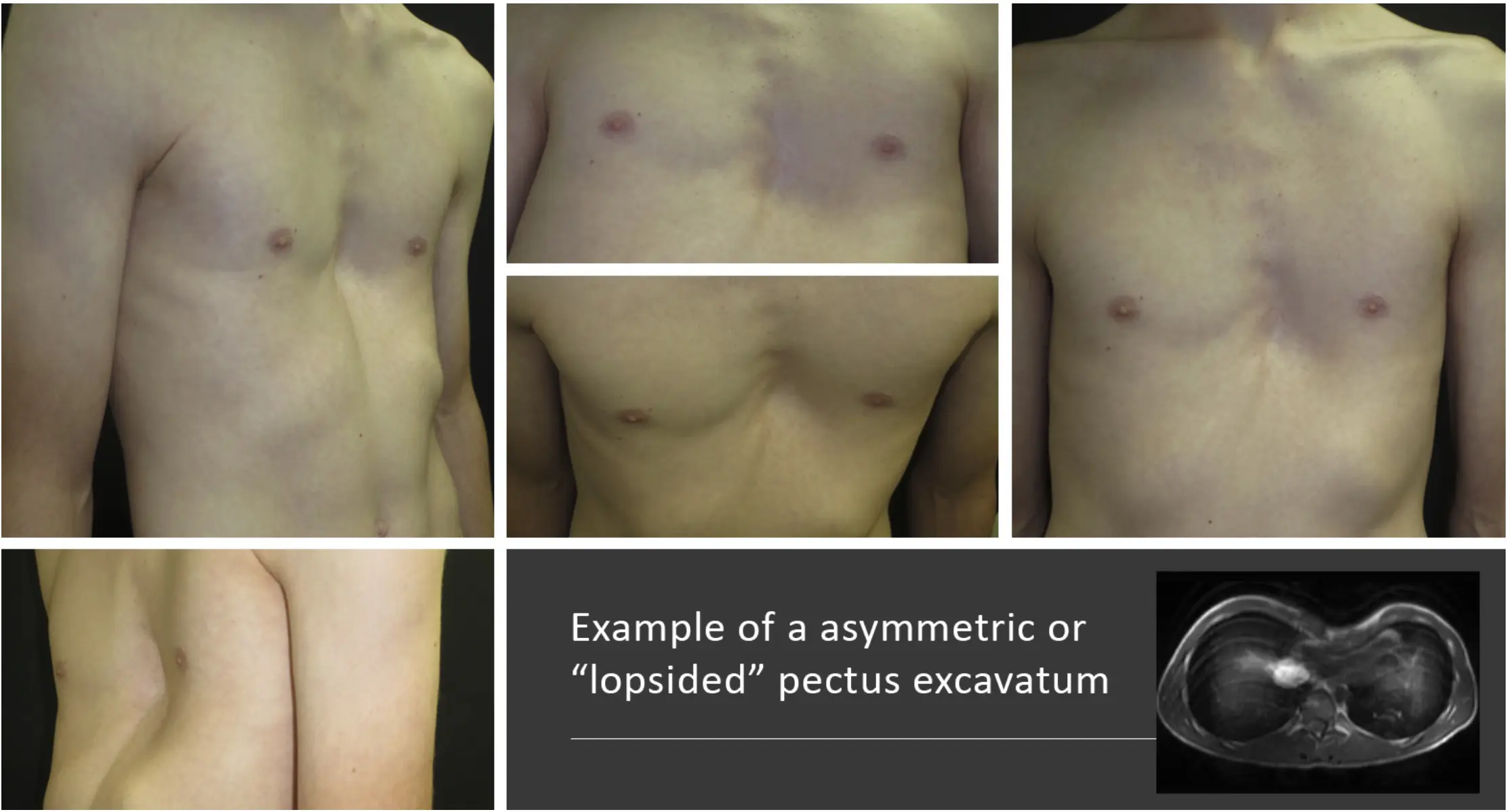 Asymmetric pectus excavatum — examples