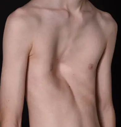 Extreme asymmetric pectus excavatum