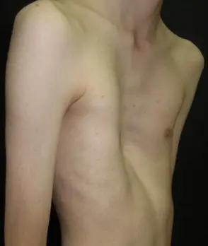 Extreme pectus excavatum — deep symmetric trench