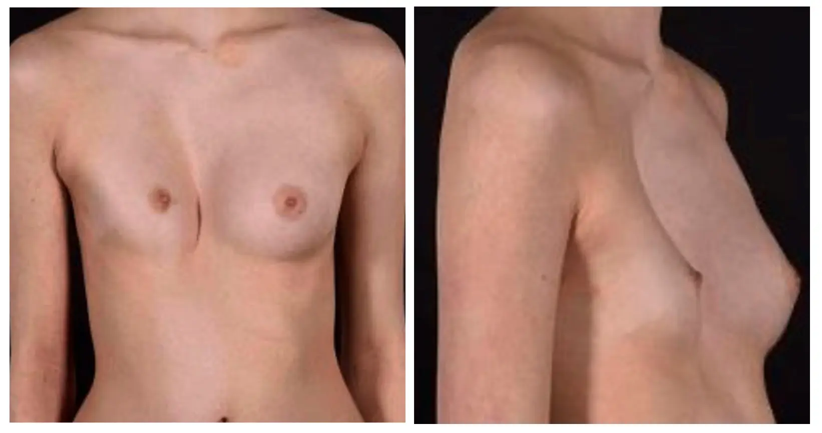 Pectus excavatum — female presentation