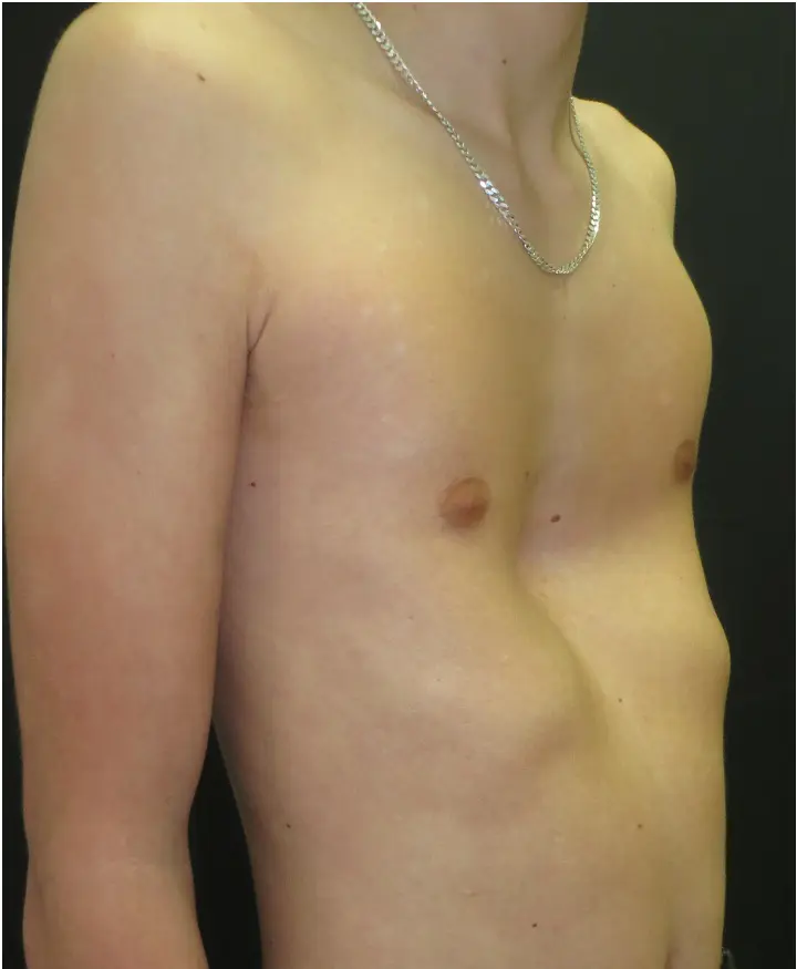 Moderate pectus excavatum with rib flaring
