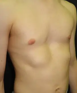 Moderate symmetrical pectus excavatum — saucer-shaped
