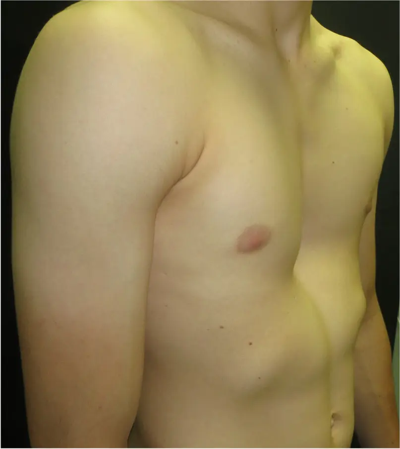 Severe asymmetric pectus excavatum — cup-shaped