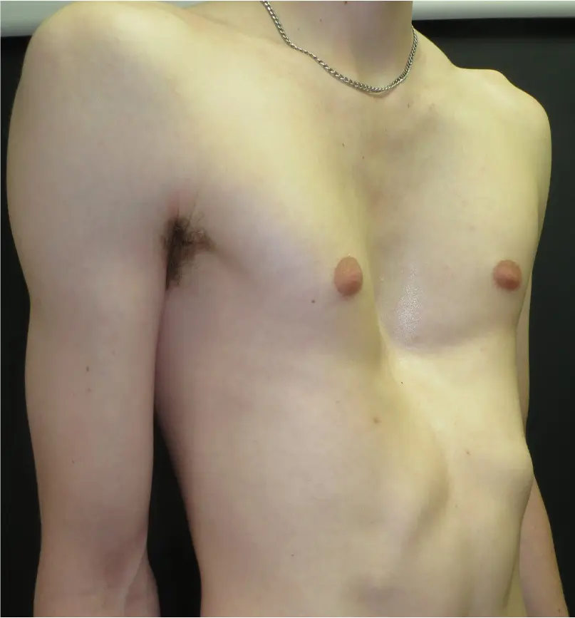 Severe symmetric pectus excavatum — trench-shaped