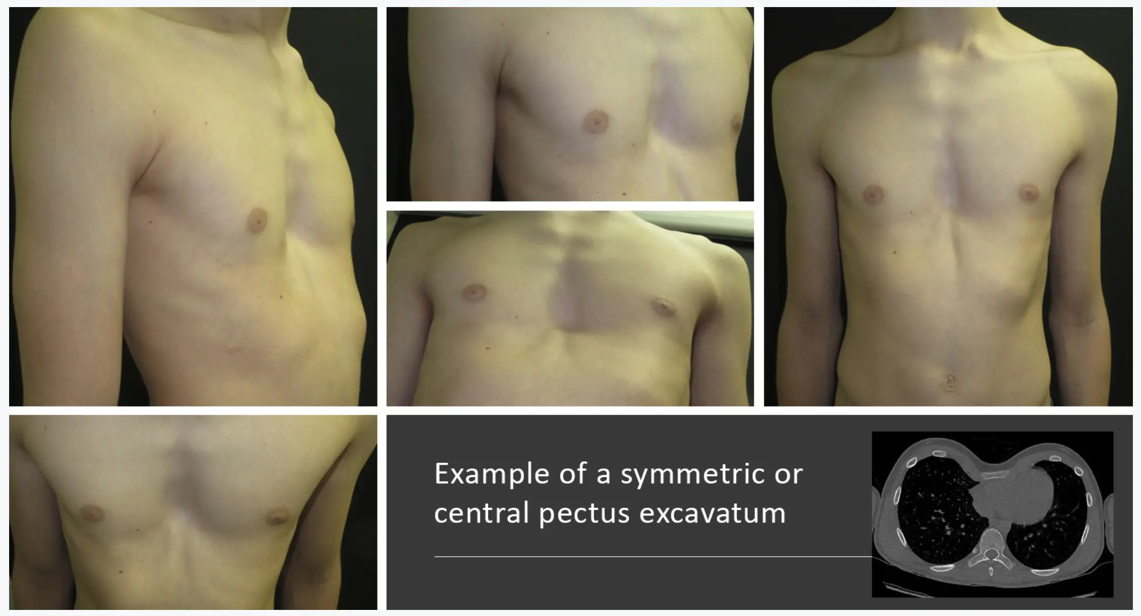 Symmetric pectus excavatum — examples