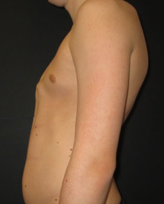 Symmetric pectus carinatum deformity and anterior pelvic tilt