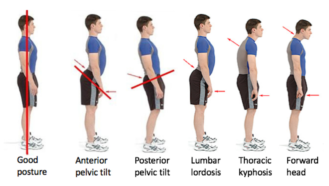 Pectus posture - pectus excavatum and carinatum are associated with other skeletal problems