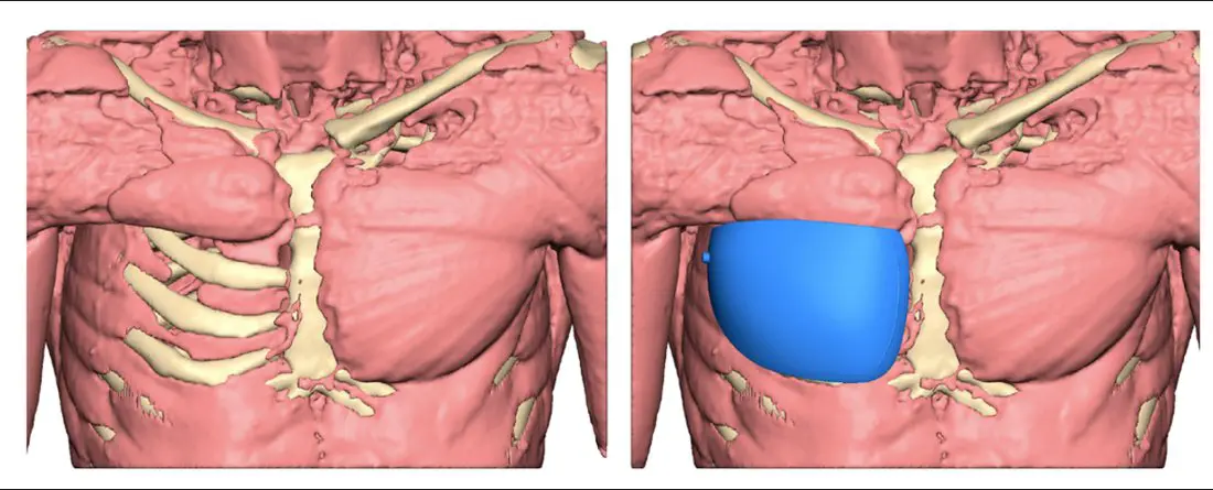 3D CT implant design for Poland syndrome — custom silicone implant shown on chest wall model, before and after placement