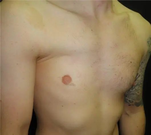 Before Poland implant — frontal oblique view showing right-sided pectoral absence and chest hollow