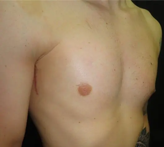 After Poland implant — frontal oblique view showing restored chest contour and symmetry