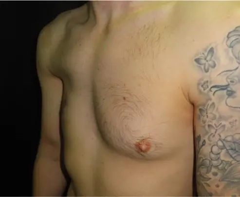 Before Poland implant — second patient, lateral oblique showing pectoral hollow