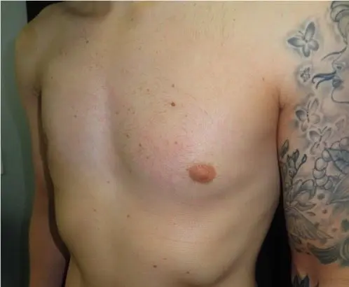 After Poland implant — second patient, lateral oblique showing restored chest contour