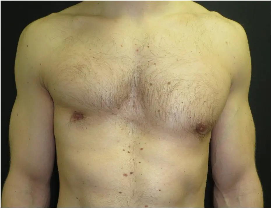 Mild Poland syndrome — subtle anterior chest asymmetry, partial pectoralis underdevelopment