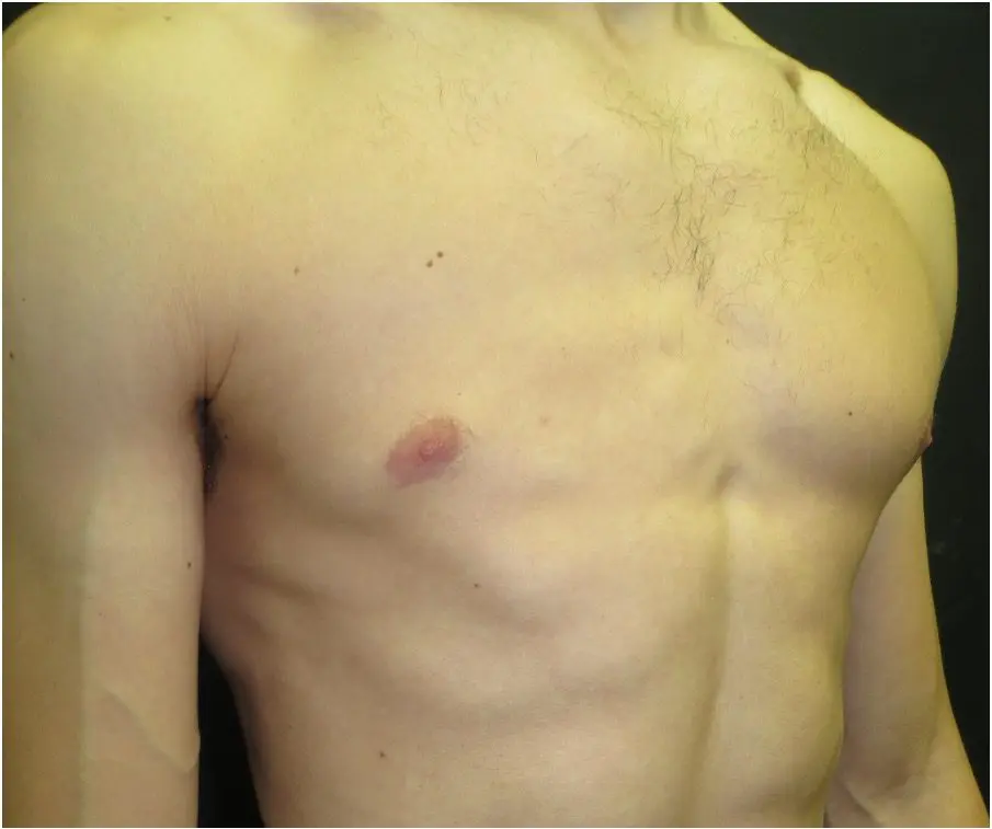 Mild Poland syndrome — partial sternocostal head underdevelopment, frontal view