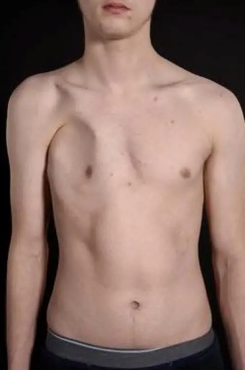 Moderate Poland syndrome in a female patient — left breast asymmetry and pectoral deficit