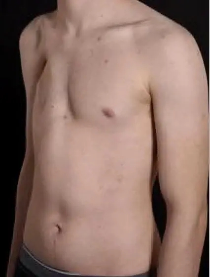 Moderate Poland syndrome in a male patient — complete pectoralis major absence, anterior chest flattening