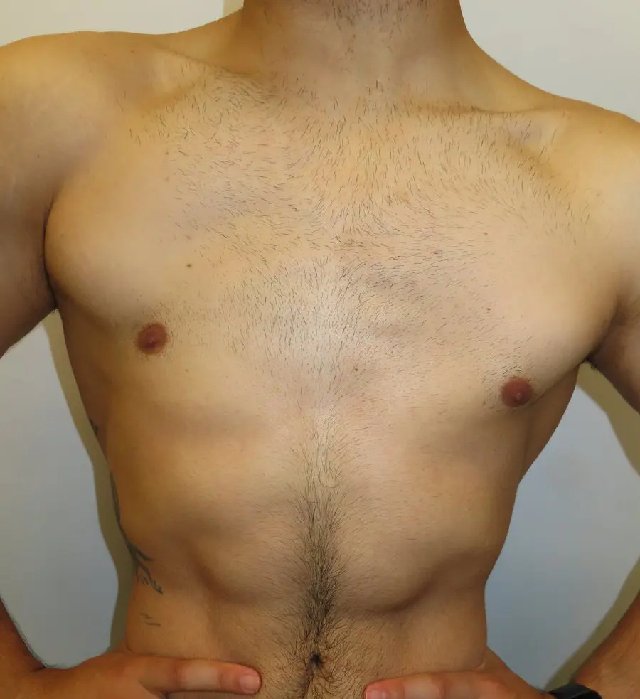 Acquired degenerative pectoral deficiency — progressive pectoralis major atrophy, Poland-like appearance, normal chest wall skeleton