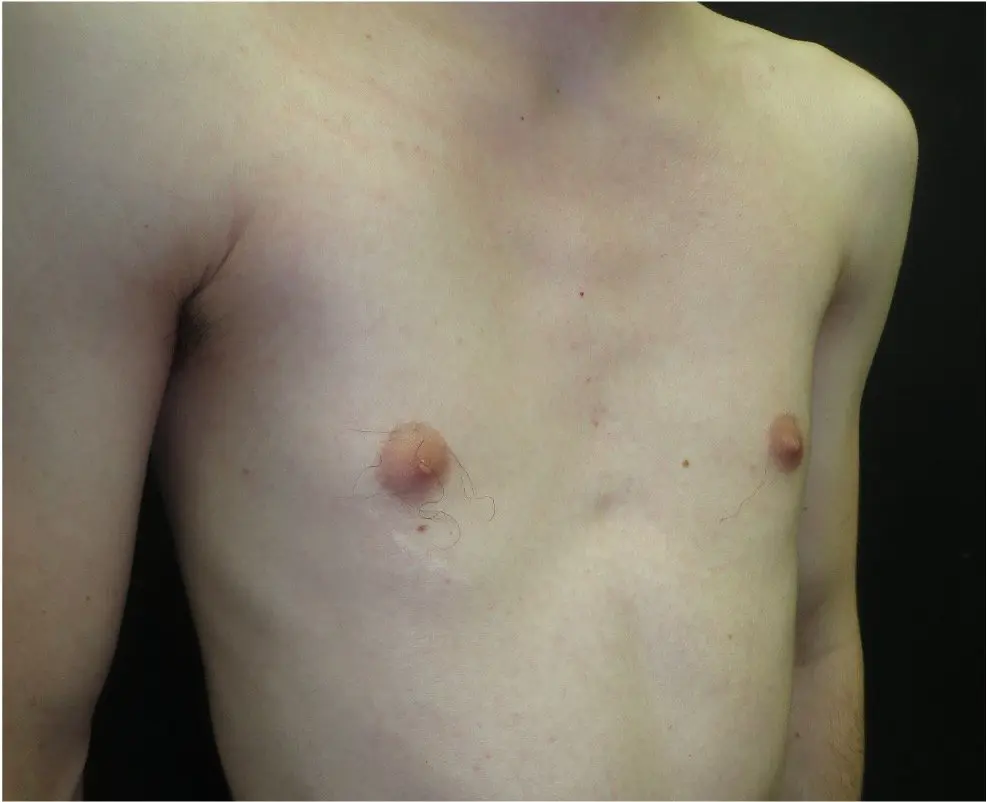Poland-like congenital pectoral underdevelopment — unilateral partial pectoralis absence without rib involvement or hand difference