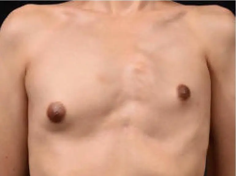 Female Poland syndrome with co-existing pectus deformity