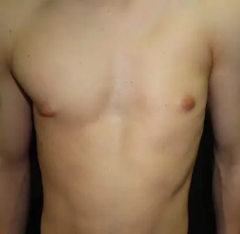 Poland syndrome — chest wall asymmetry from absent pectoralis major