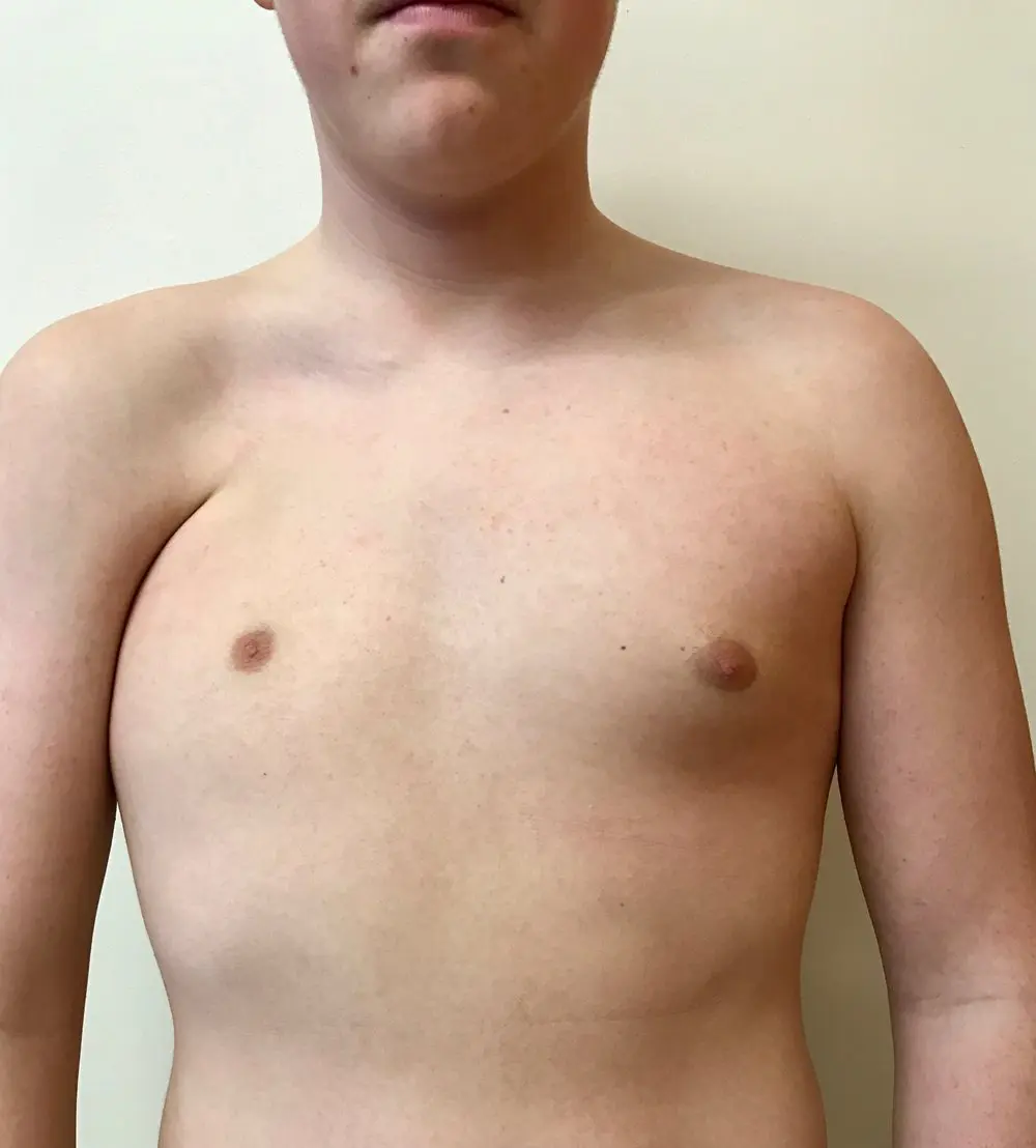 Severe Poland syndrome — complete unilateral pectoralis absence with marked chest wall asymmetry