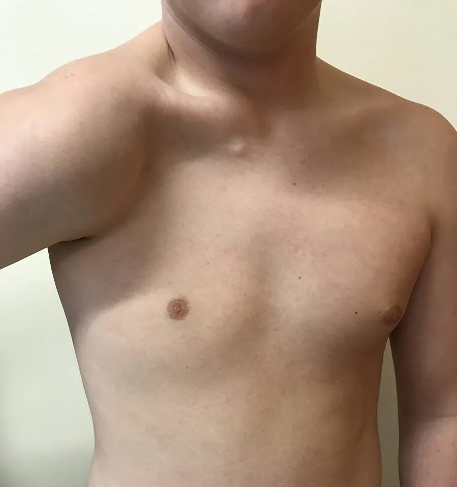 Severe Poland syndrome — right shoulder hypermobility and drooping secondary to absent clavicular pectoral attachment