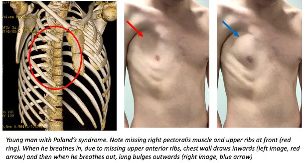 Clinical illustration — severe Poland syndrome with absent right costal cartilage, paradoxical breathing shown