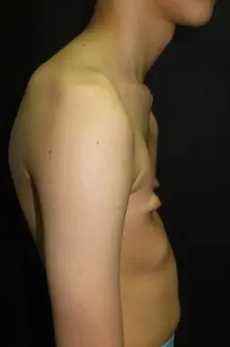 Lateral full-body view showing combined postural changes in pectus patient